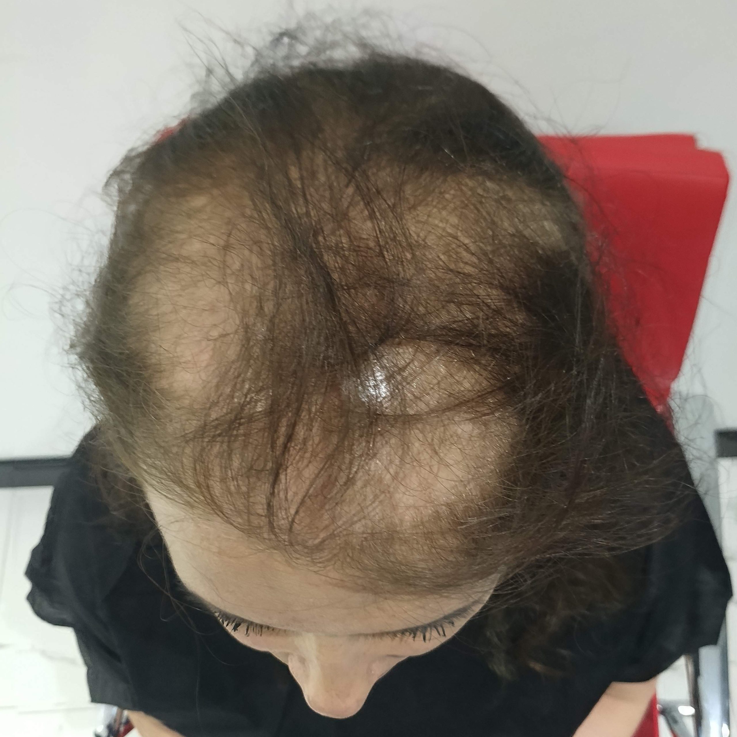 Hair Transplant Review