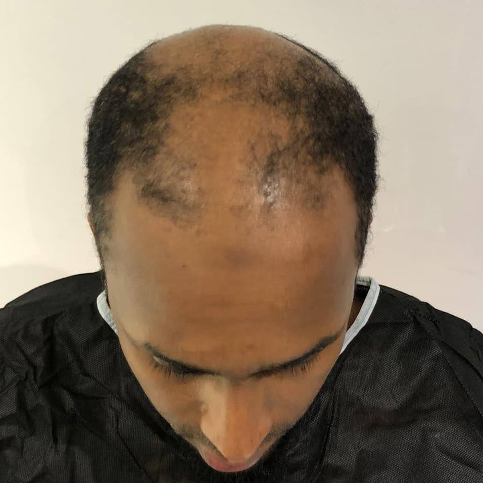 Hair Transplant Review