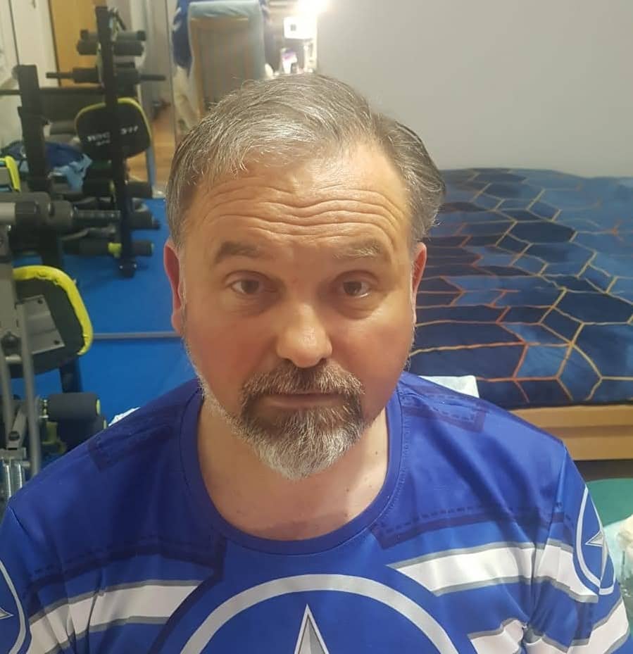 Hair Transplant Review